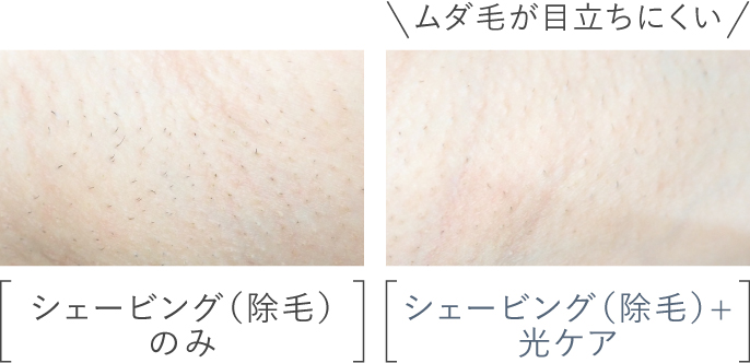 写真：ムダ毛処理後の肌を比較,「シェービング（除毛）のみ」、「シェービング（除毛）＋光ケア：ムダ毛が目立ちにくい」