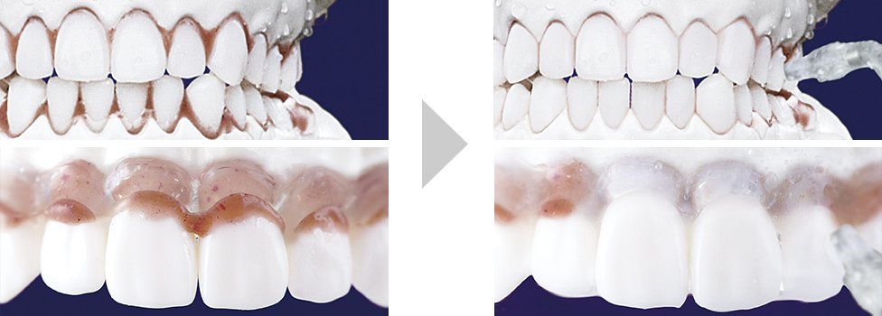 写真：歯磨き後に残った歯周ポケットの汚れや、歯間の汚れをしっかり洗い流すイメージ